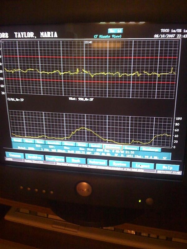 The bottom line shows that her contractions are 5 mins apart